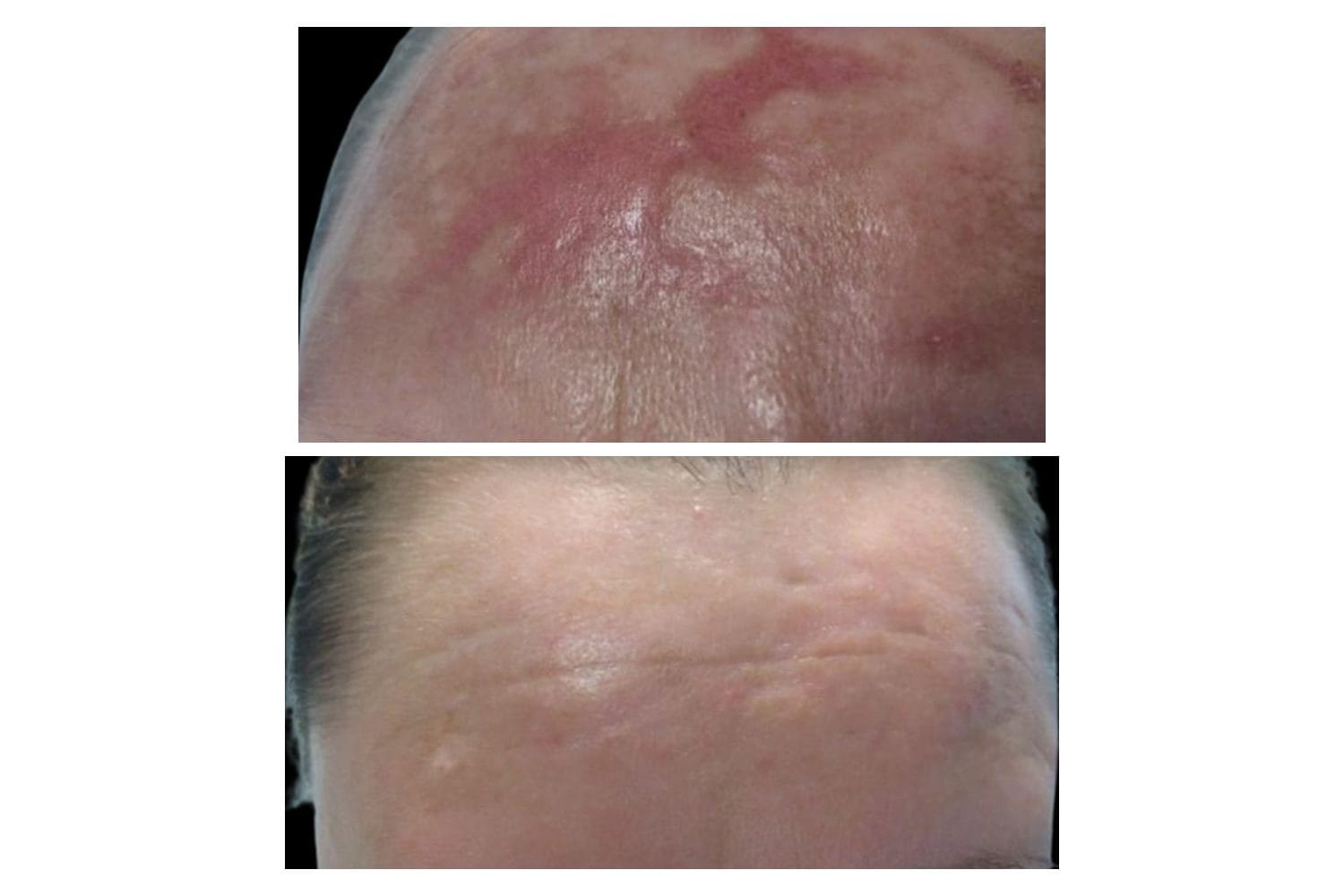 Scarlet SRF before and after &middot; Forehead / scarring & burns