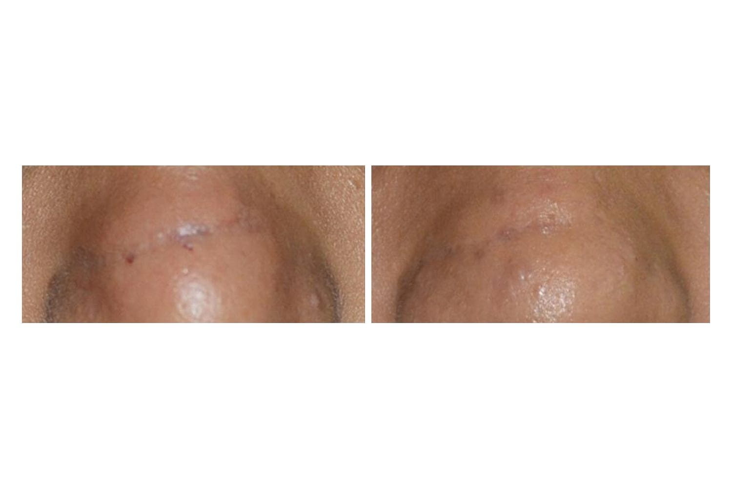 Scarlet SRF before and after &middot; Forehead / scarring & burns