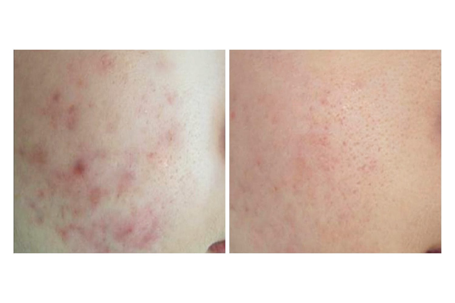 Scarlet SRF before and after &middot; Face / acne