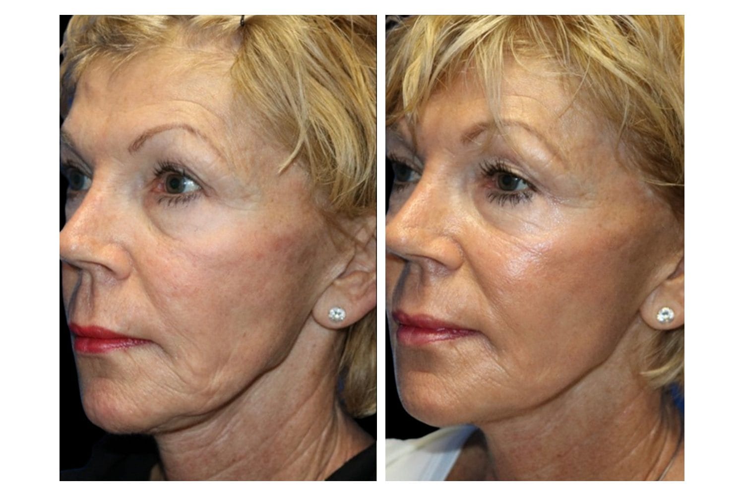 Scarlet SRF before and after &middot; Face / fine lines & deep wrinkles