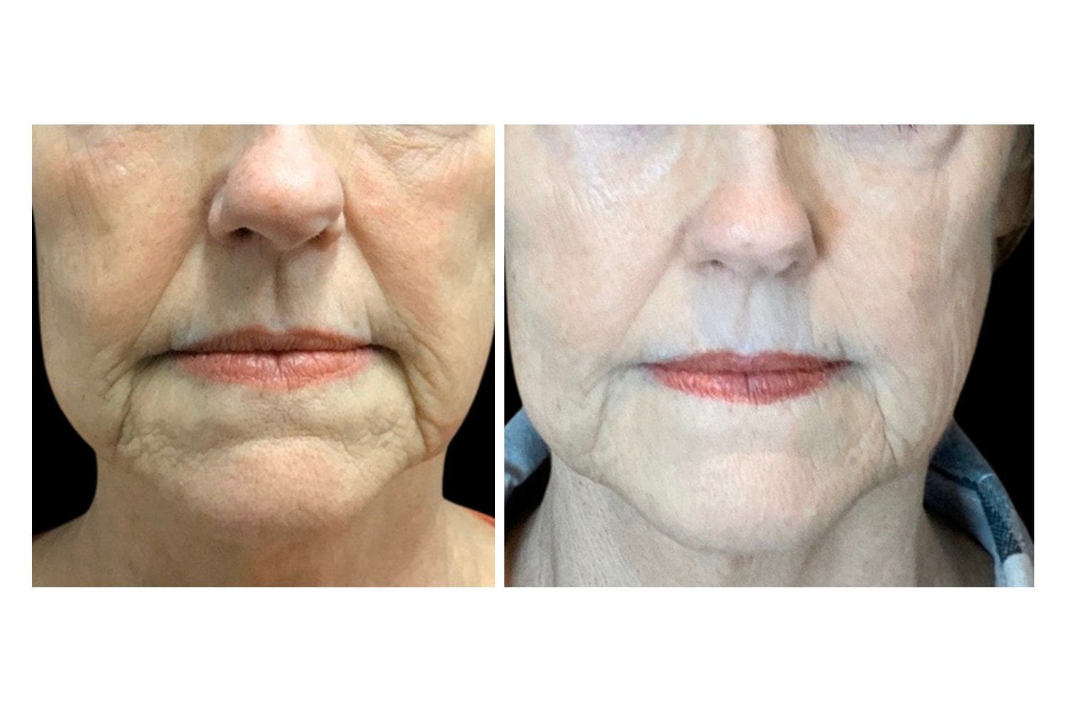 Scarlet SRF before and after &middot; Lower face & neck / fine lines