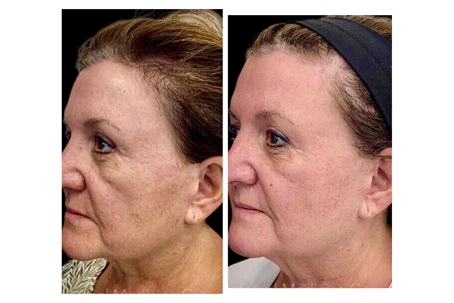 Scarlet SRF before and after &middot; Face / hyperpigmentation