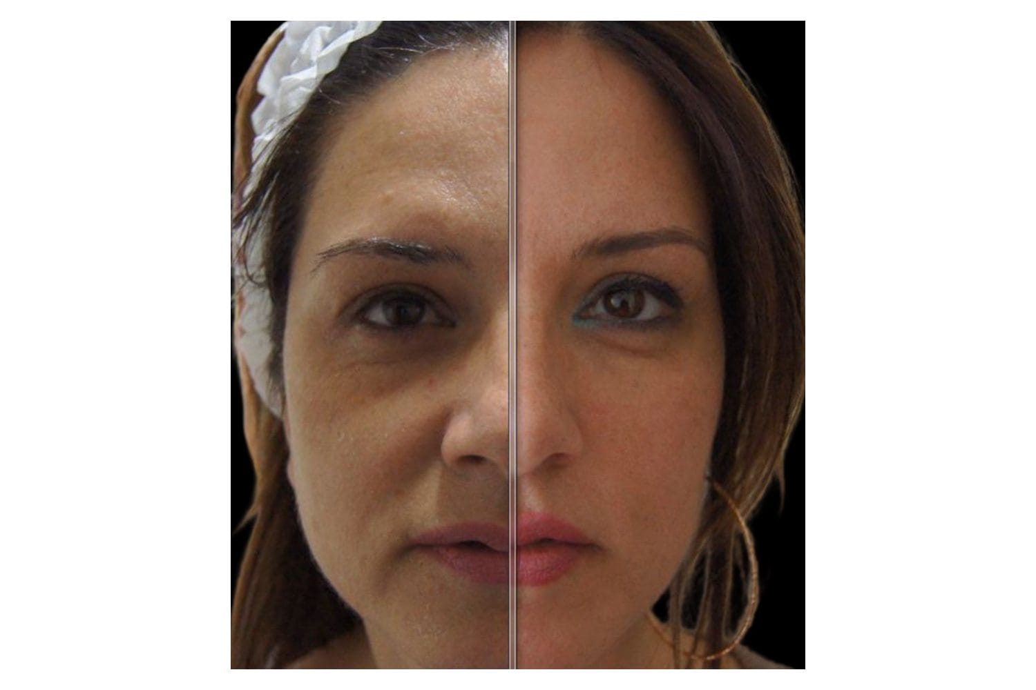 Scarlet SRF before and after &middot; Face / skin lifting