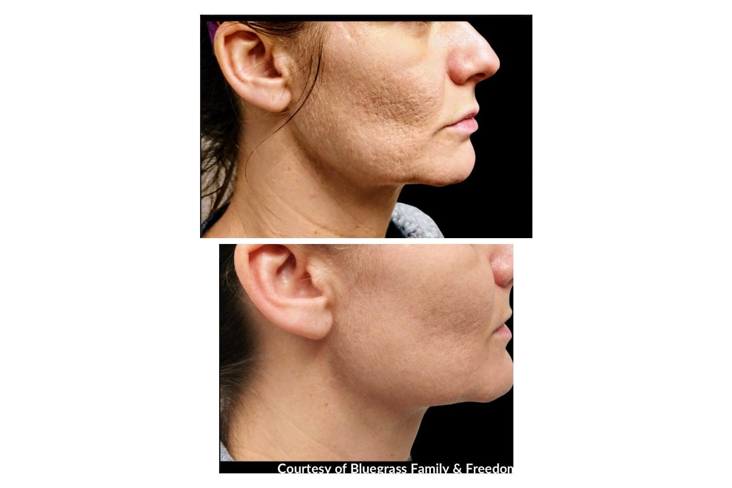Scarlet SRF before and after &middot; Face / skin texture