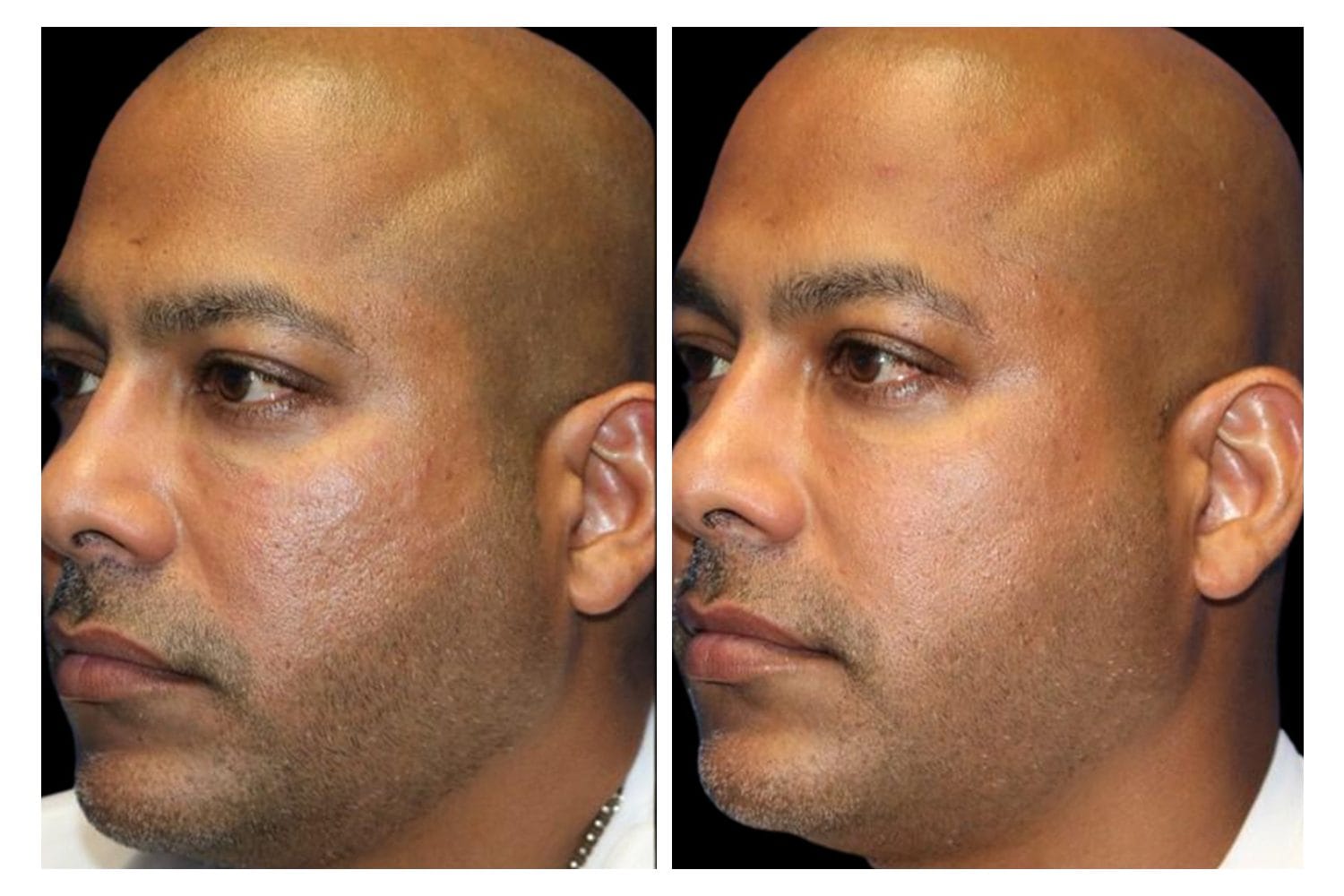 Scarlet SRF before and after &middot; Face / skin texture