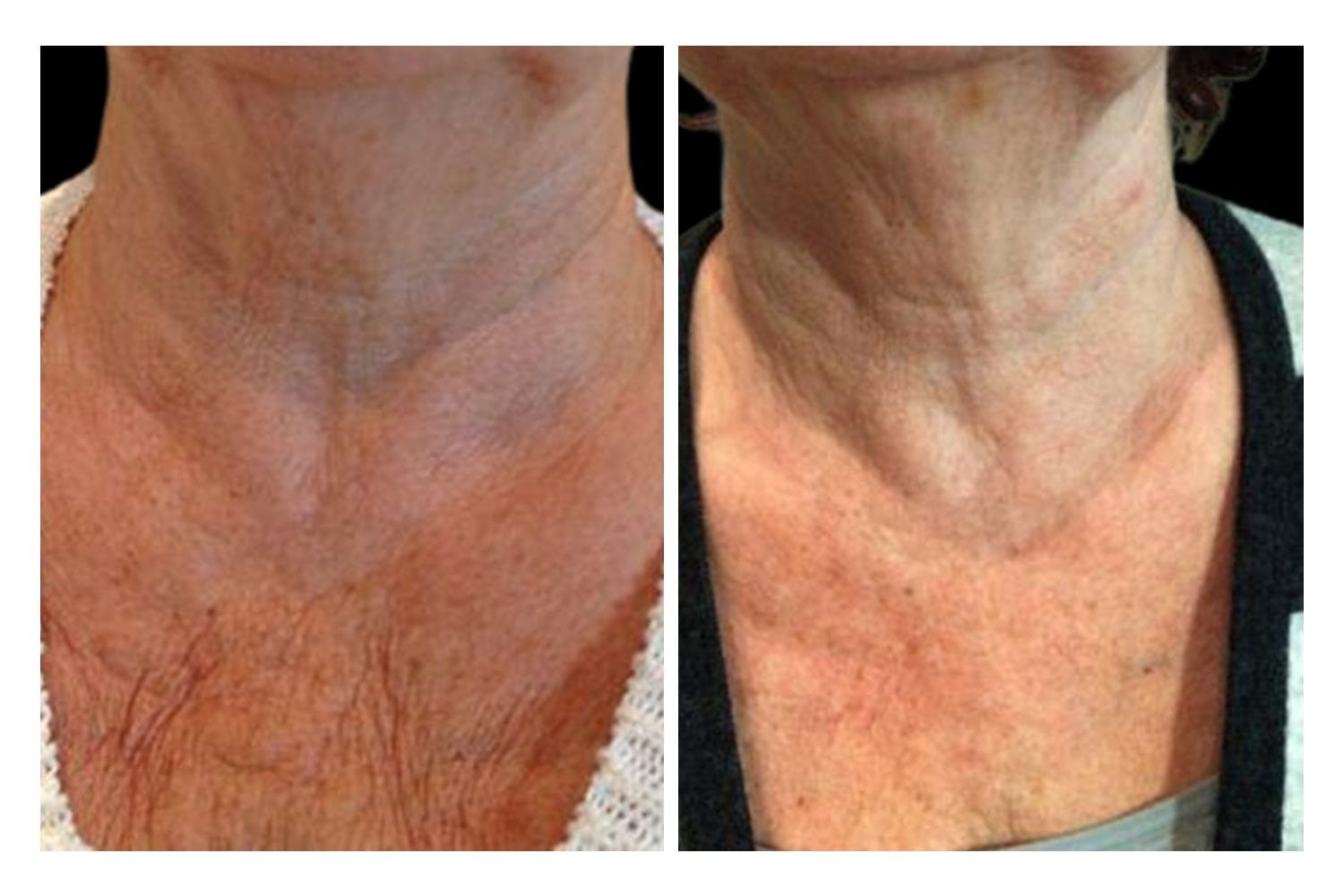 Scarlet SRF before and after &middot; D&eacute;colletage / skin tightening