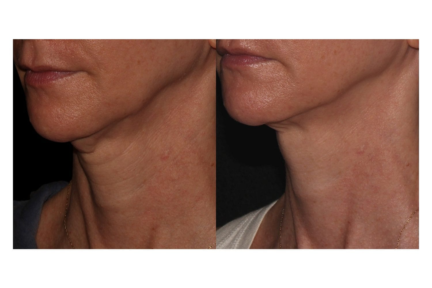 Scarlet SRF before and after &middot; Jawline & neck / skin tightening