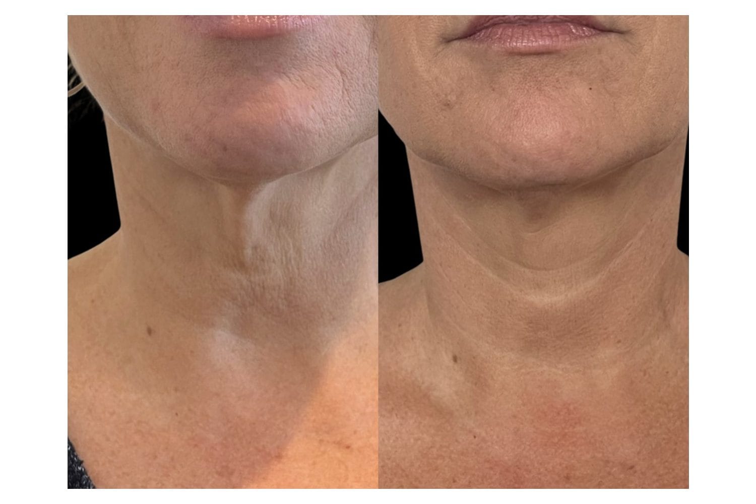 Scarlet SRF before and after &middot; Neck / skin tightening