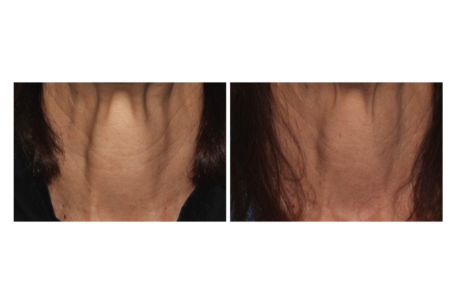Scarlet SRF before and after &middot; D&eacute;colletage / skin tightening
