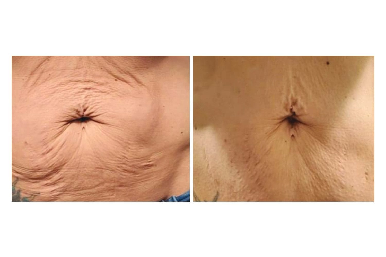 Scarlet SRF before and after &middot; Abdomen / skin tightening