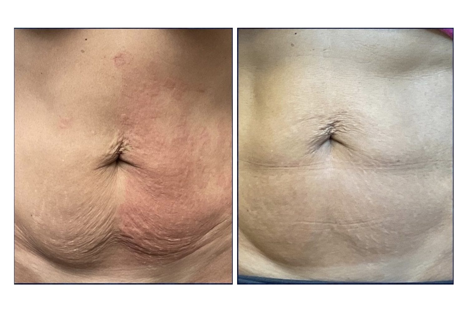 Scarlet SRF before and after &middot; Abdomen / skin tightening