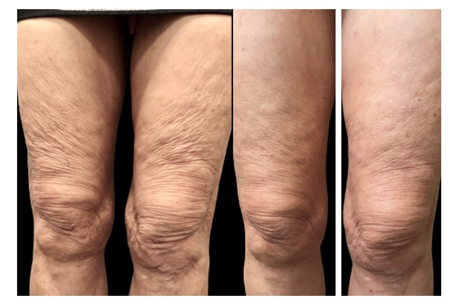 Scarlet SRF before and after &middot; Knees & thighs / skin tightening
