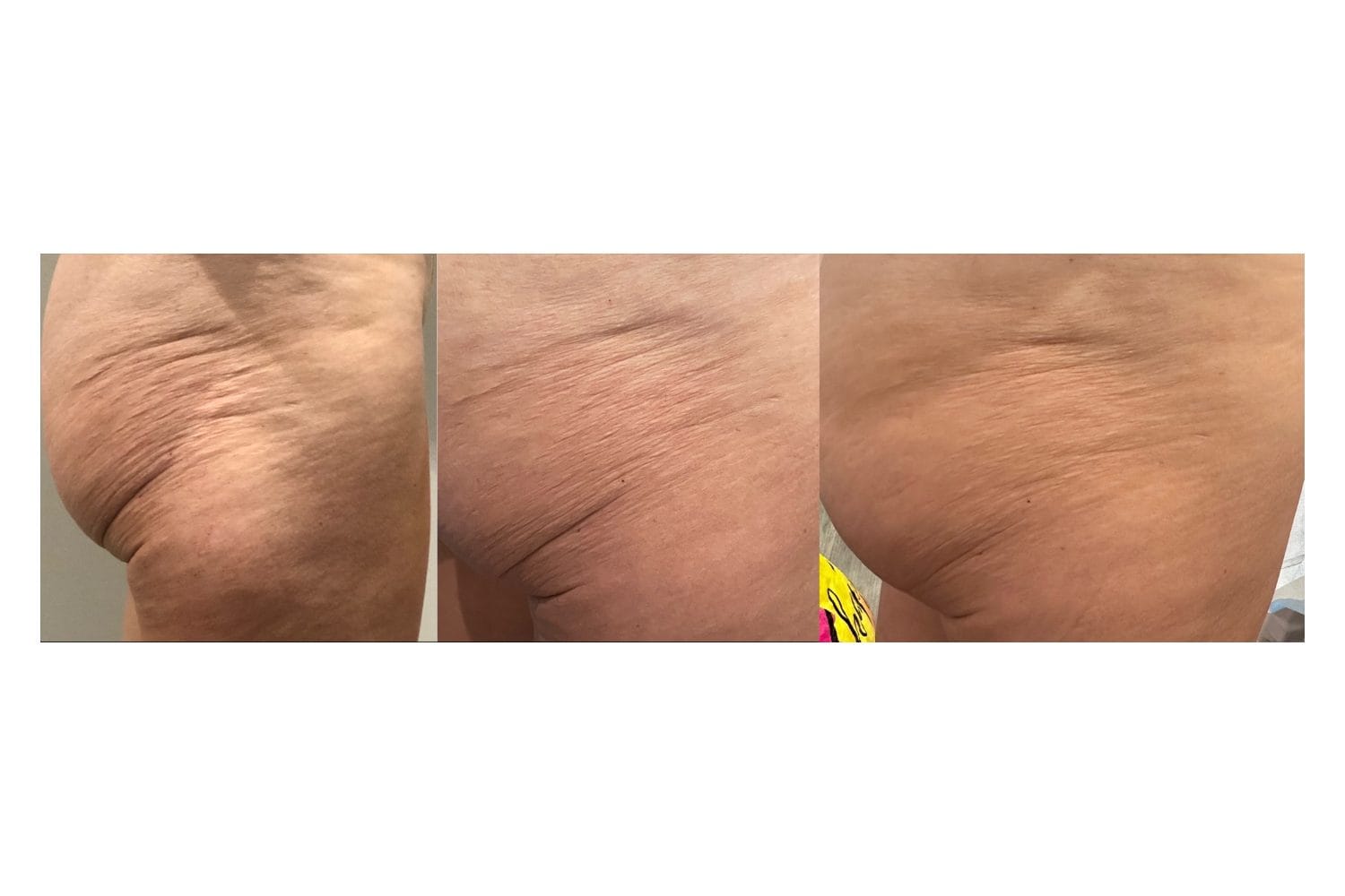 Scarlet SRF before and after &middot; Buttocks & thighs / skin tightening