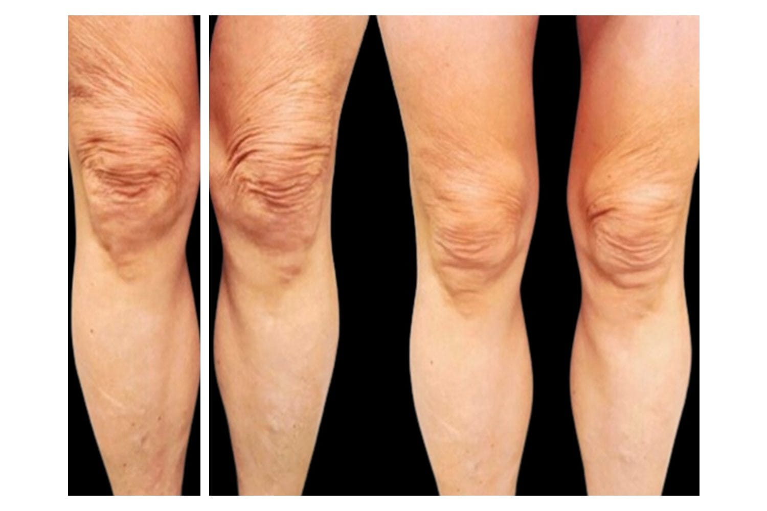 Scarlet SRF before and after &middot; Knees & legs / skin tightening