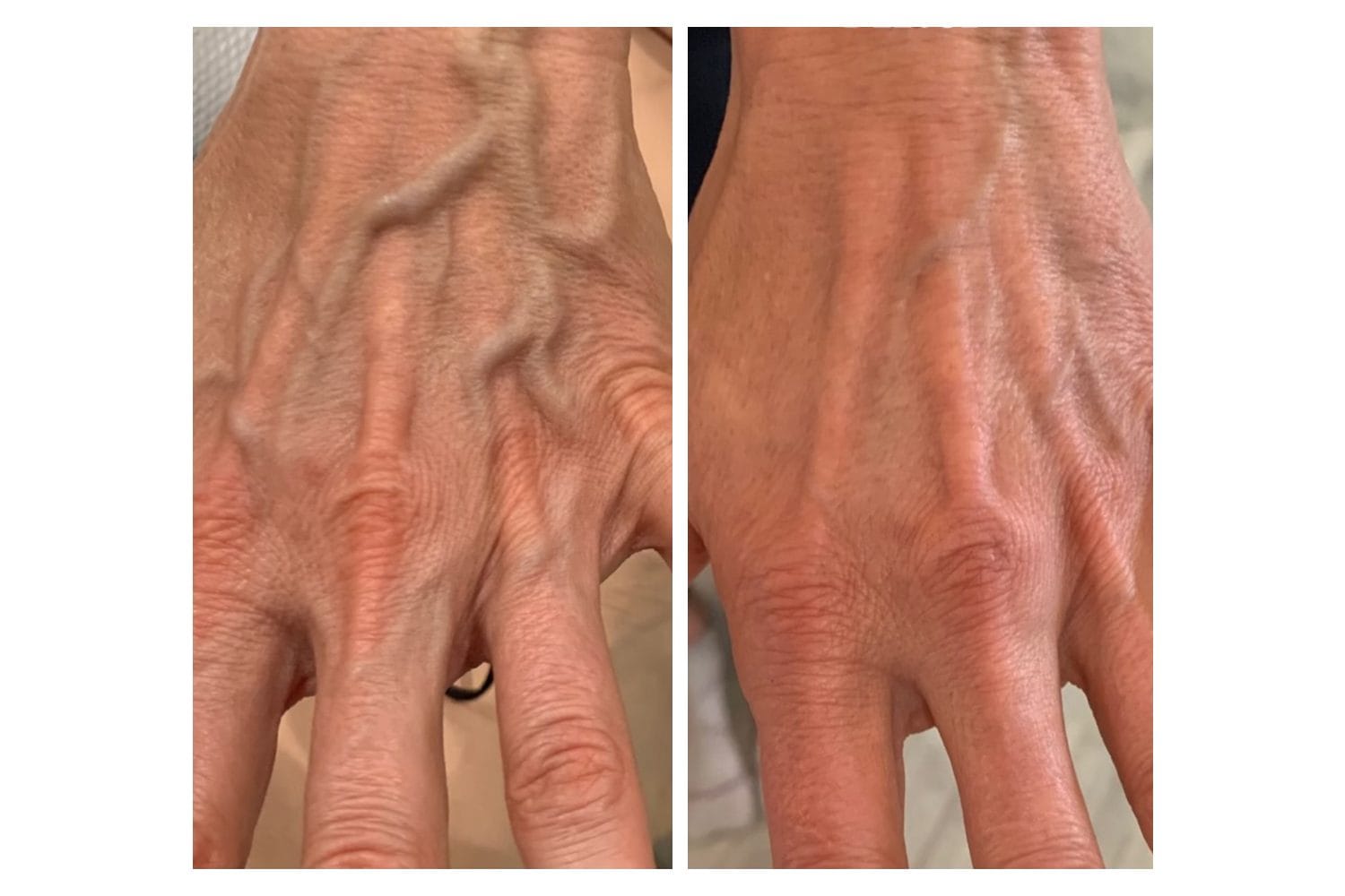 Scarlet SRF before and after &middot; Hands / skin tightening