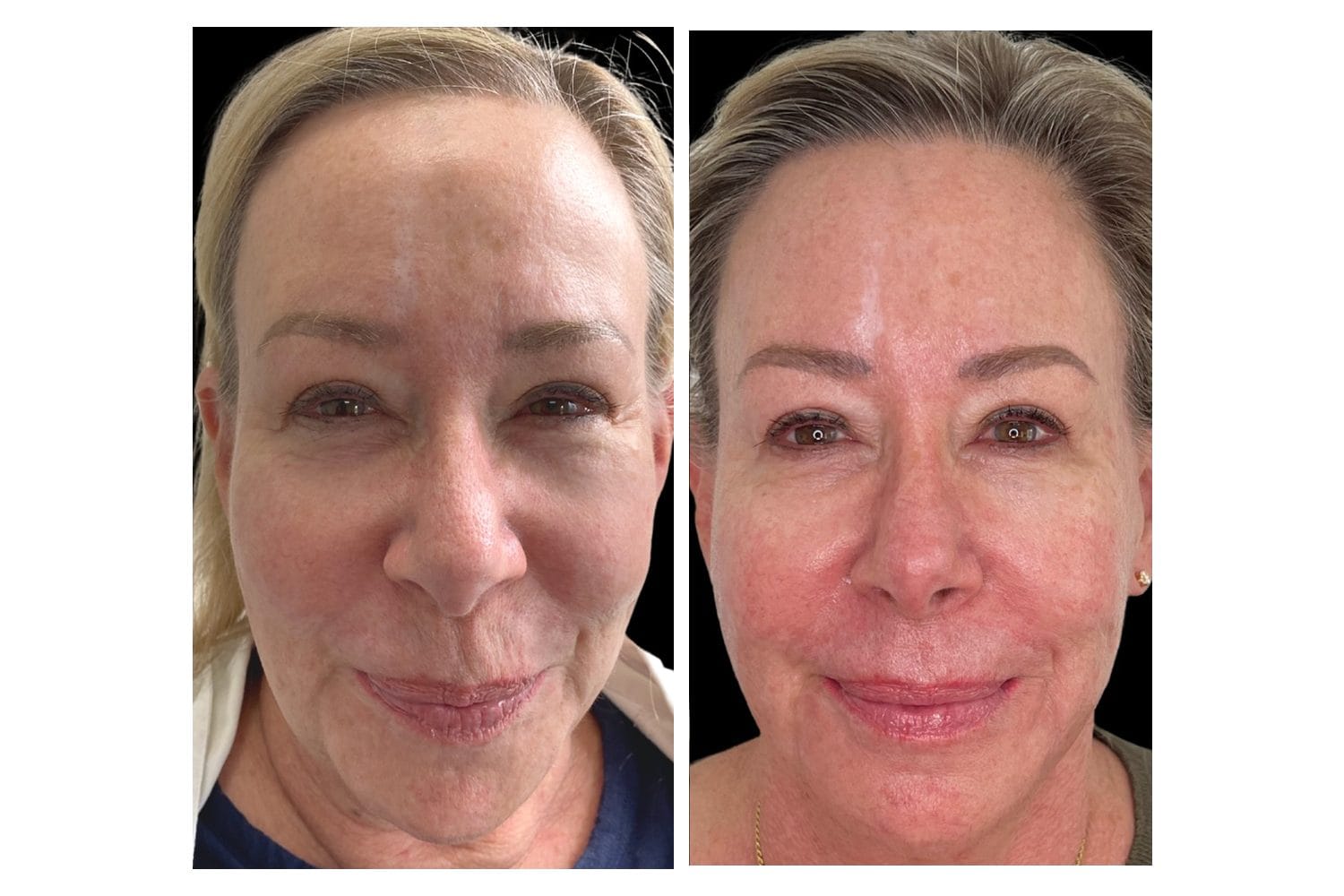 Scarlet SRF before and after &middot; Face / overall rejuvenation