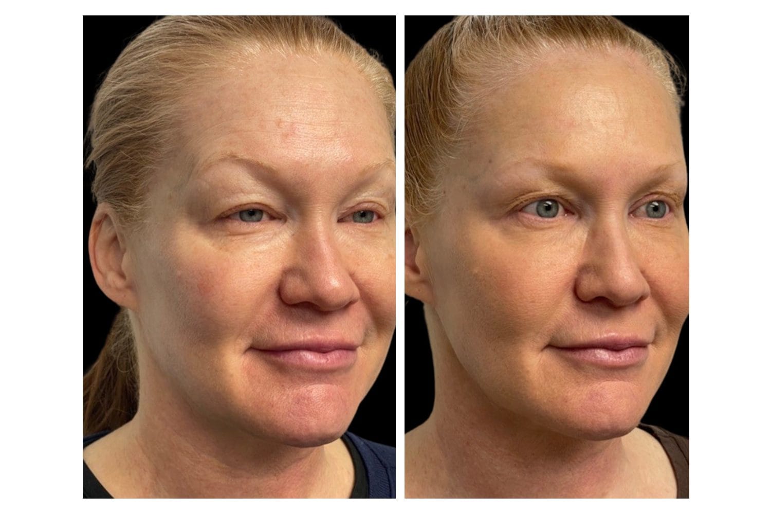 Scarlet SRF before and after &middot; Face / overall rejuvenation