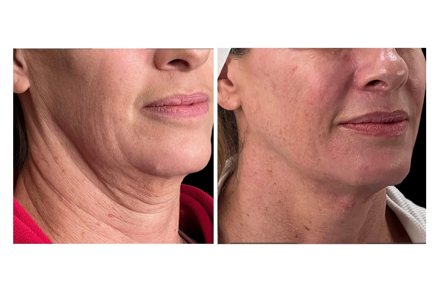 Scarlet SRF before and after &middot; Jawline & neck / laxity