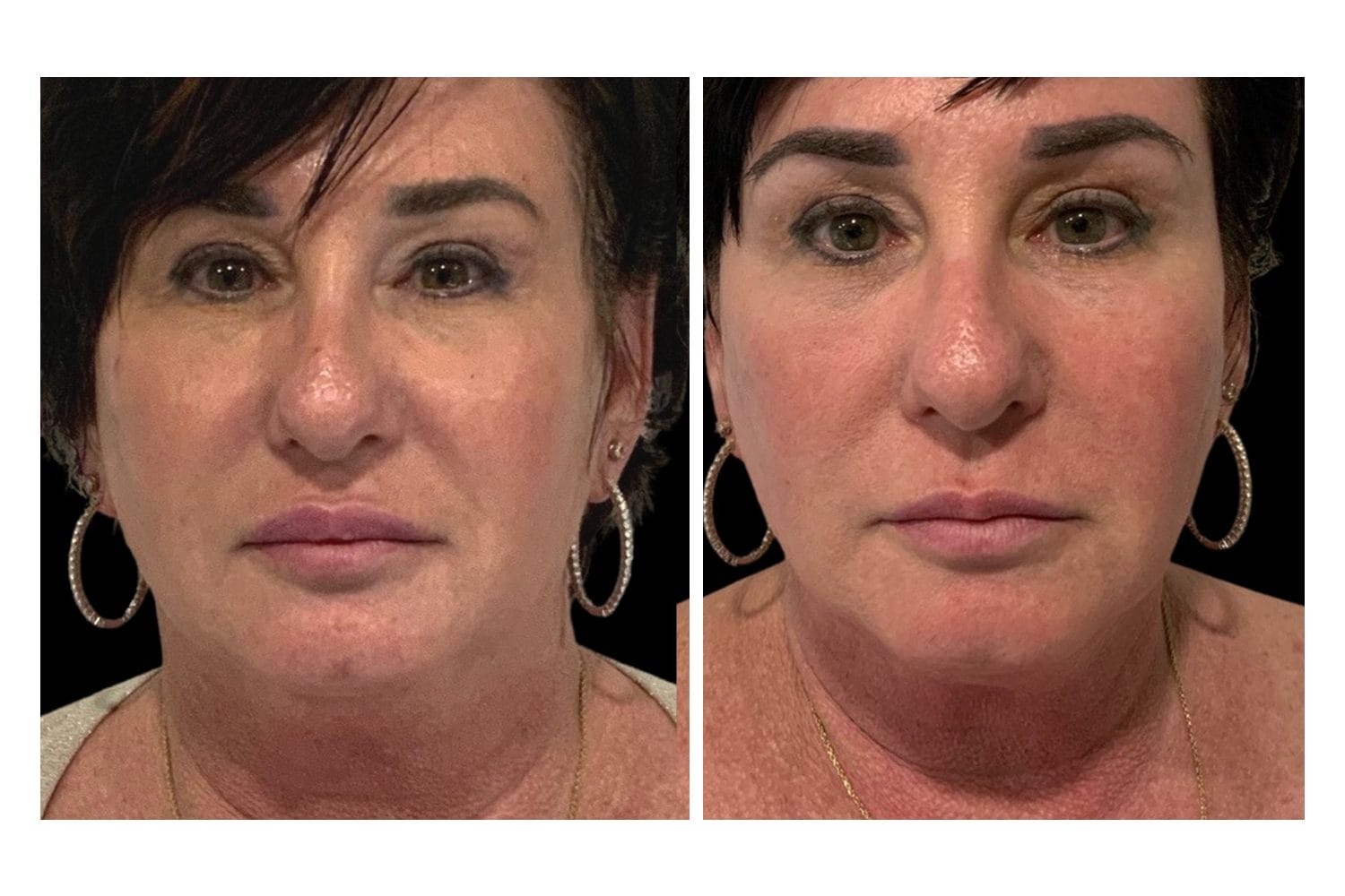 Scarlet SRF before and after &middot; Face / overall rejuvenation
