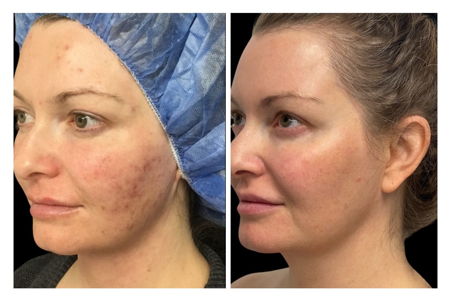 Scarlet SRF before and after &middot; Face / acne & redness
