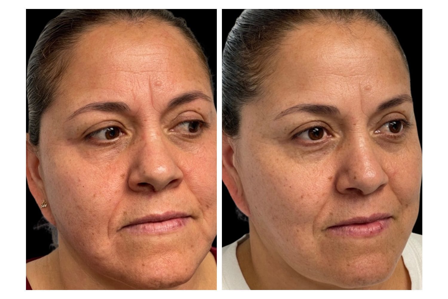 Scarlet SRF before and after &middot; Face / overall rejuvenation